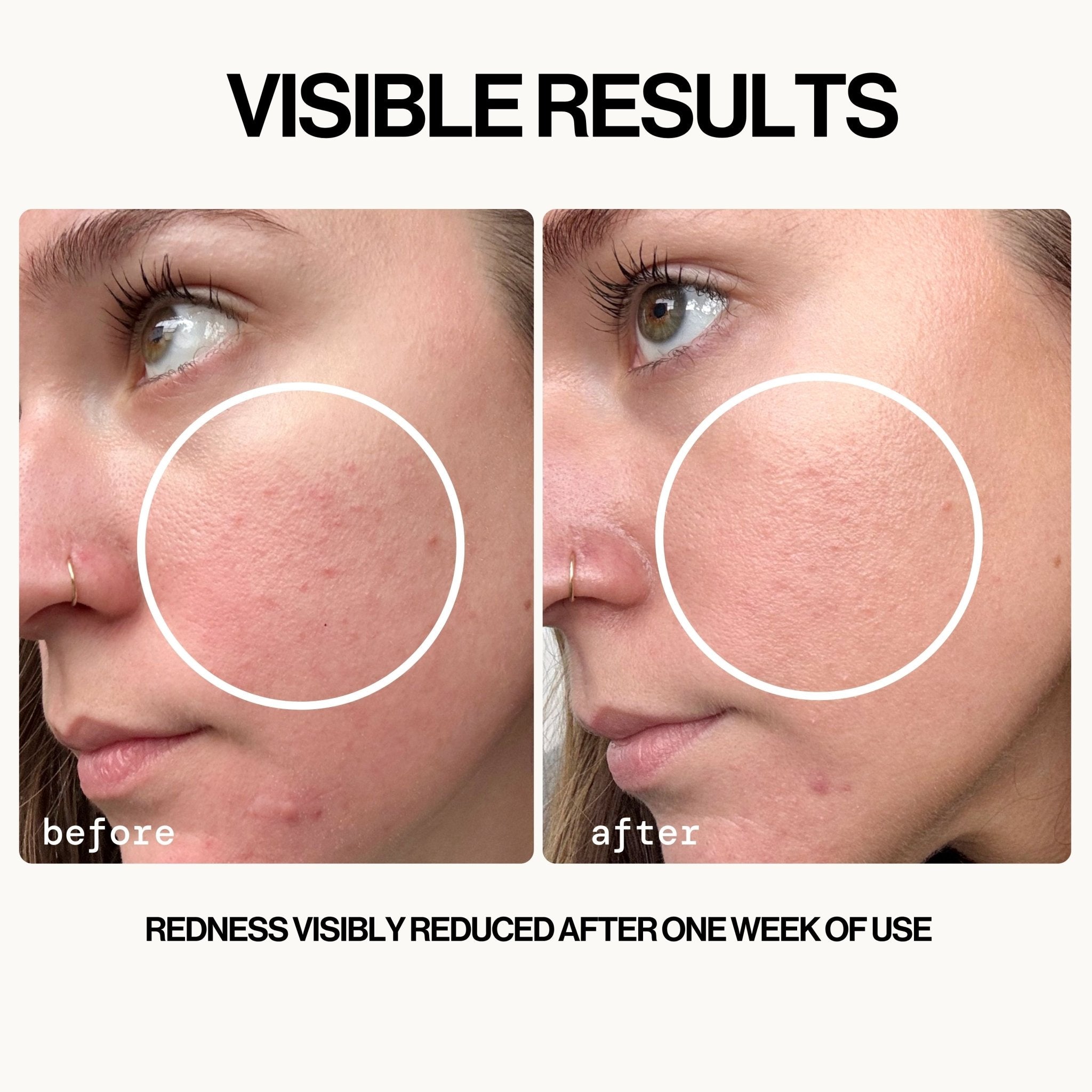 Before and after comparison of skin redness reduction with text 'Visible Results' and 'Redness Visibly Reduced After One Week of Use'.